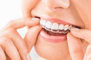 Read more about the article Invisalign Dentist in Bangalore