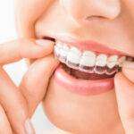 Read more about the article Invisalign Braces Cost in Bangalore