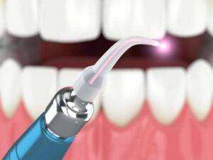 LASER TEETH WHITENING IN BANGALORE