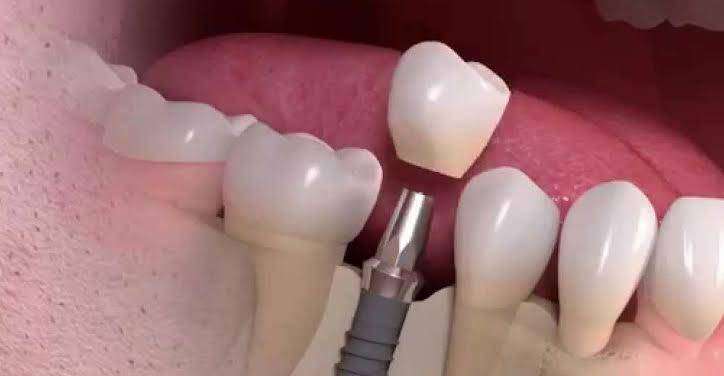 Dental Implants