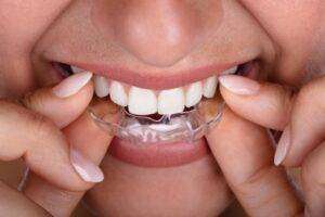 Read more about the article BEST INVISIBLE RETAINERS IN BANGALORE