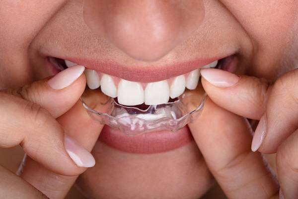 You are currently viewing BEST INVISIBLE RETAINERS IN BANGALORE