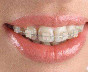 Read more about the article Ceramic Braces in Bangalore