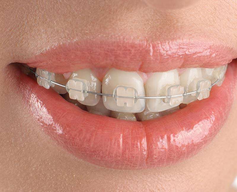 You are currently viewing Ceramic braces cost in bangalore india