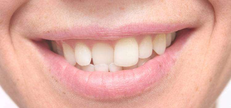 You are currently viewing Dental Veneers in Bangalore