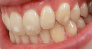 Read more about the article FLUOROSIS TREATMENT IN BANGALORE