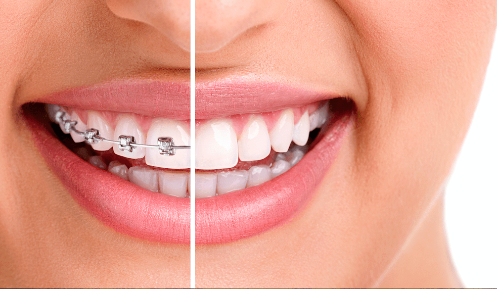 Metal Braces cost in Bangalore - Amaya Dental Clinic