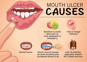 Read more about the article What causes mouth ulcers and its treatment