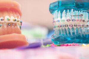 Read more about the article ORTHODONTIC TREATMENT BRACES