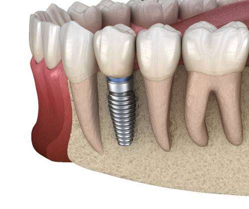 You are currently viewing Dental Implants in Bangalore