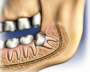 Read more about the article Wisdom tooth extraction in bangalore