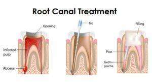 Root Canal Charges Bangalore