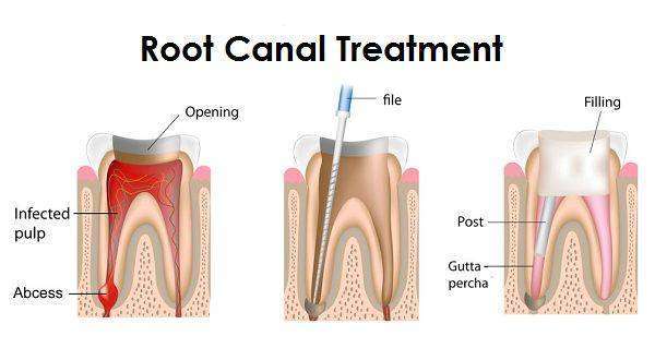 You are currently viewing Root Canal Charges Bangalore