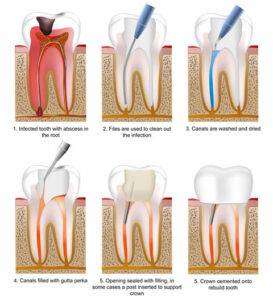 Read more about the article PAINLESS ROOT CANAL TREATMENT, SINGLE SITTING RCT- BANGALORE