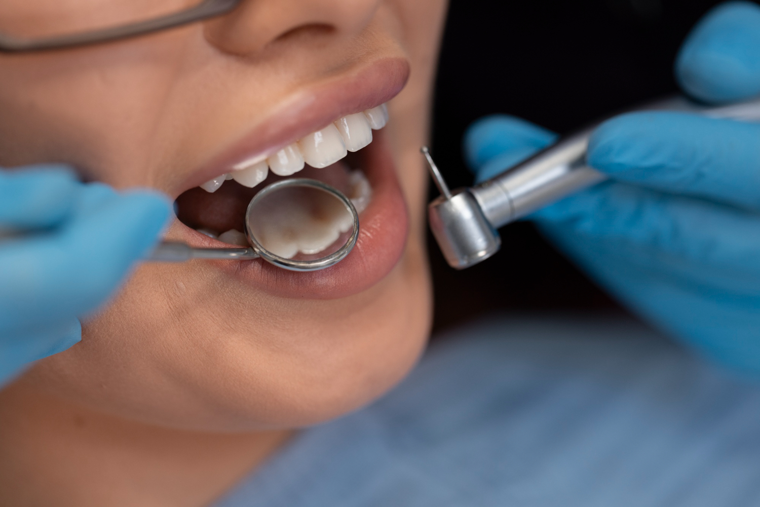 You are currently viewing All About Dental Bonding – Best Smile Makeover in Bangalore